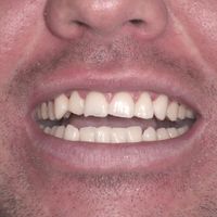 Composite Bonding - Smile 1 before